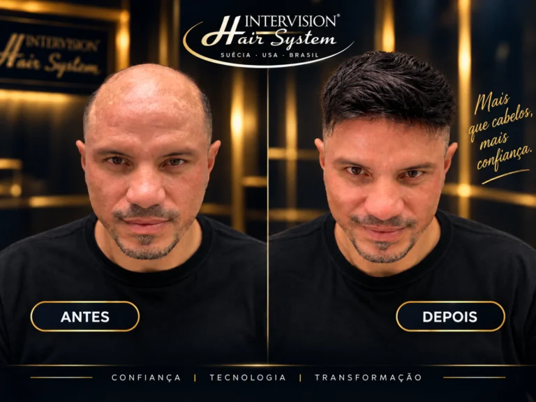 Antes e depois real de prótese capilar Samuel Intervision Hair System