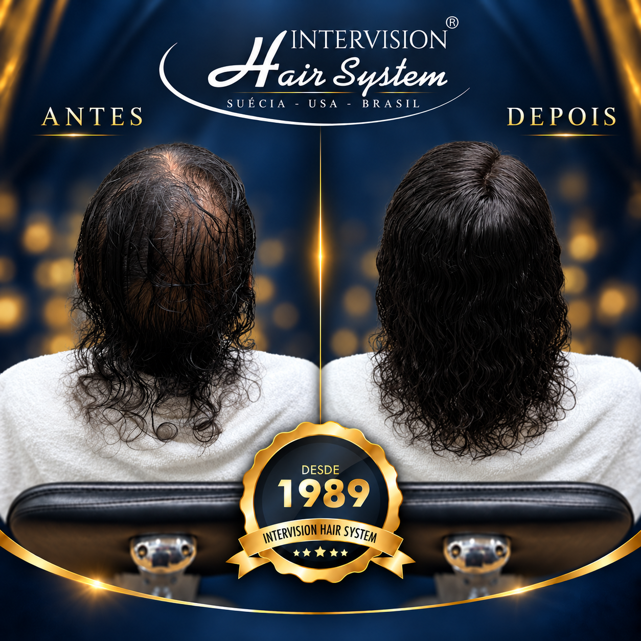 Antes e depois de prótese capilar - resultado real Intervision Hair System em Brasília 01