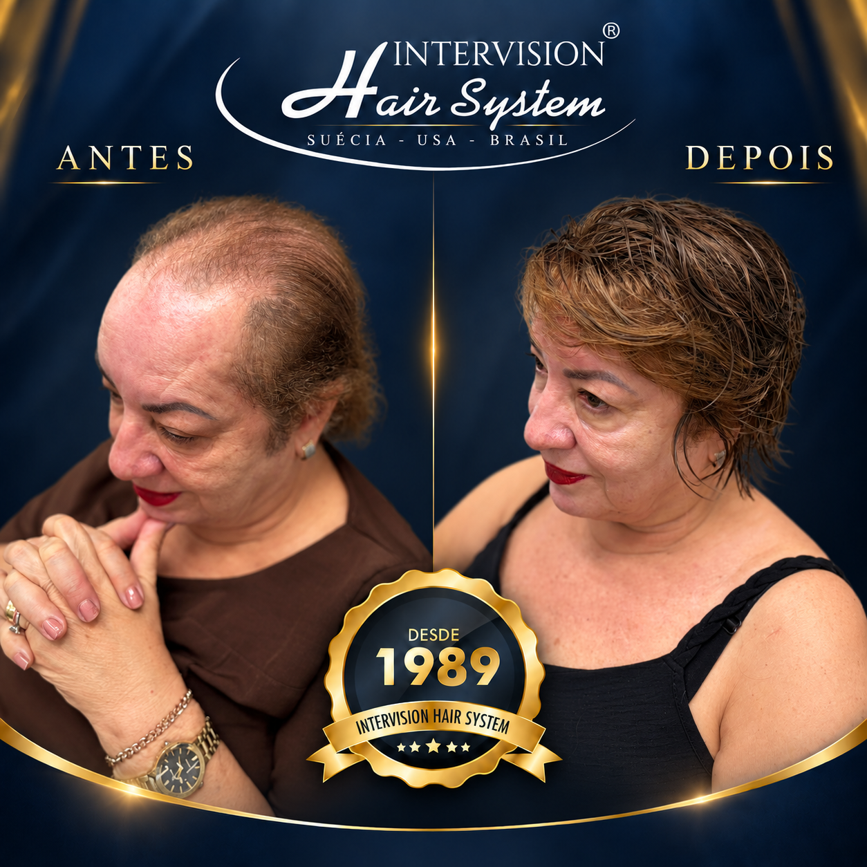 Antes e depois de prótese capilar - resultado real Intervision Hair System em Brasília 03