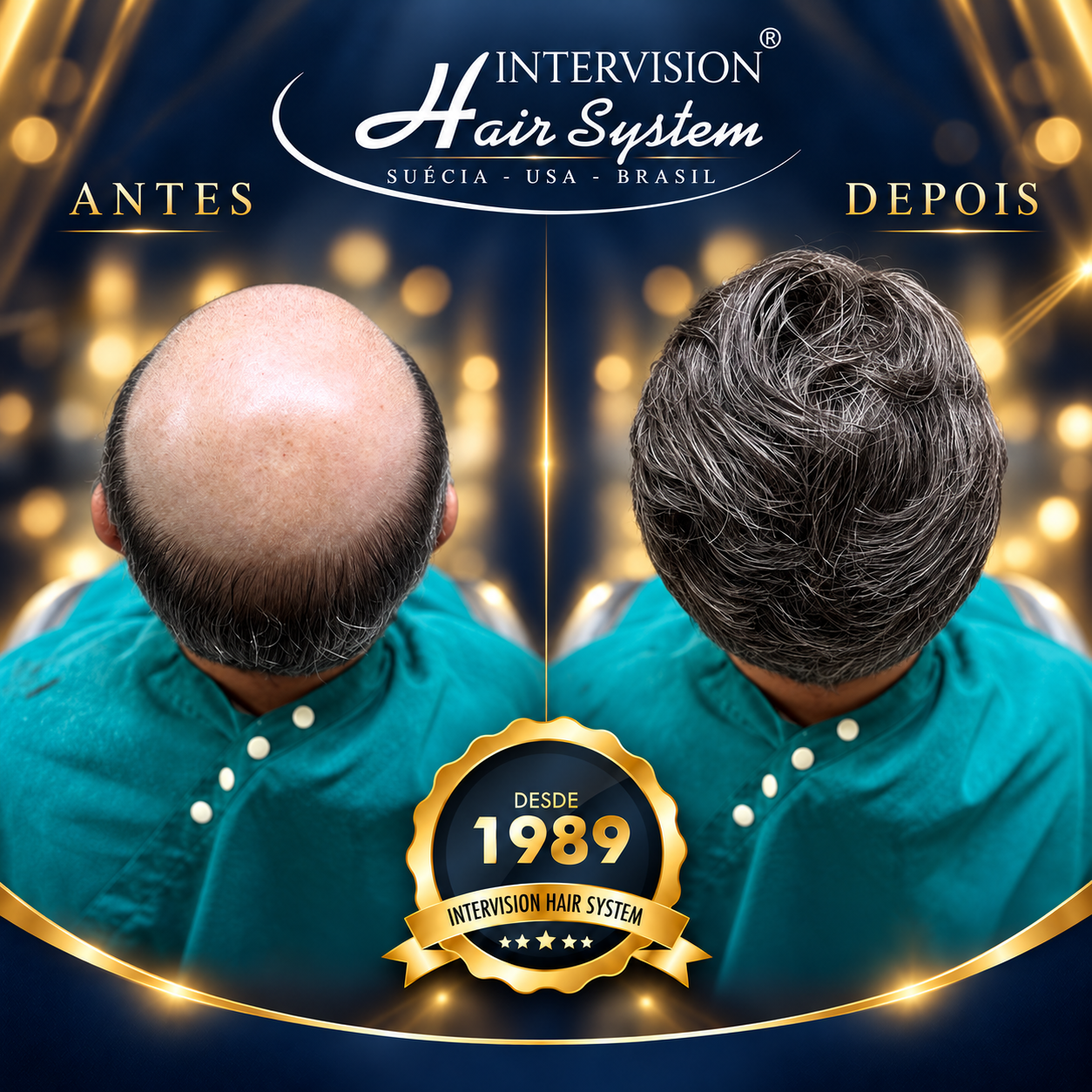 Antes e depois de prótese capilar - resultado real Intervision Hair System em Brasília 04