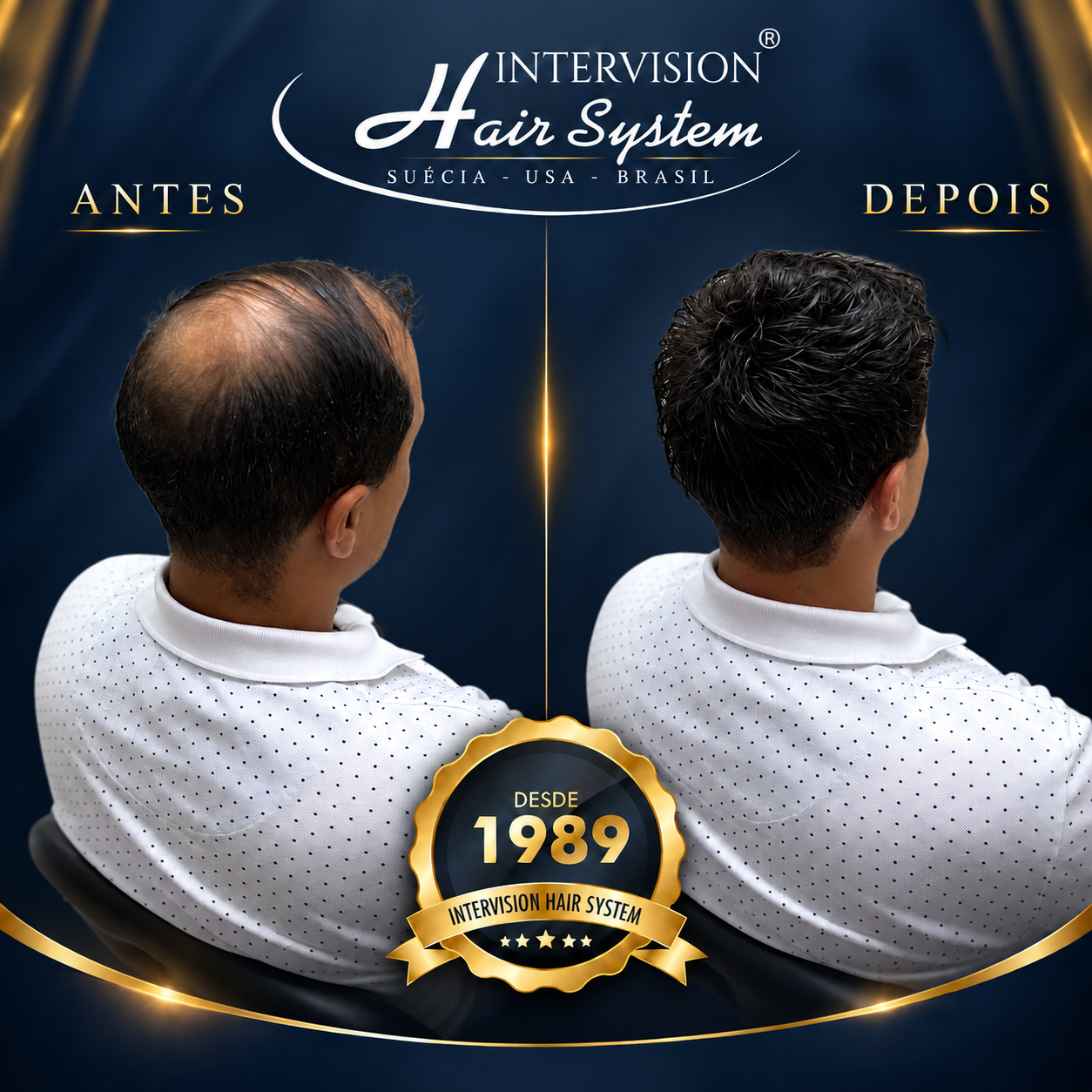 Antes e depois de prótese capilar - resultado real Intervision Hair System em Brasília 06