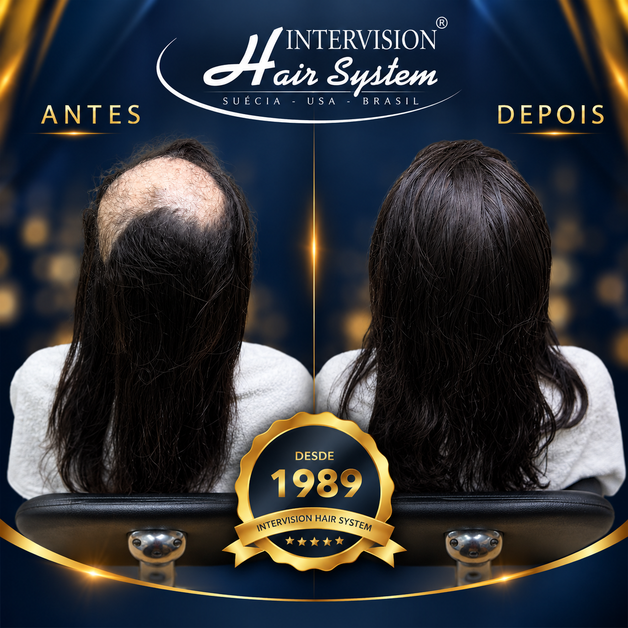 Antes e depois de prótese capilar - resultado real Intervision Hair System em Brasília 07