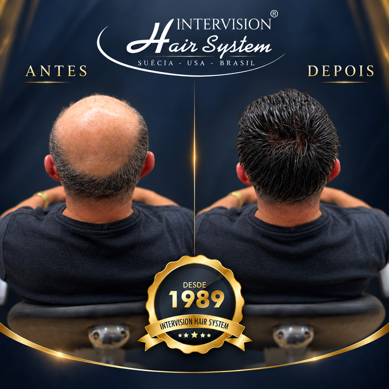 Antes e depois de prótese capilar - resultado real Intervision Hair System em Brasília 08