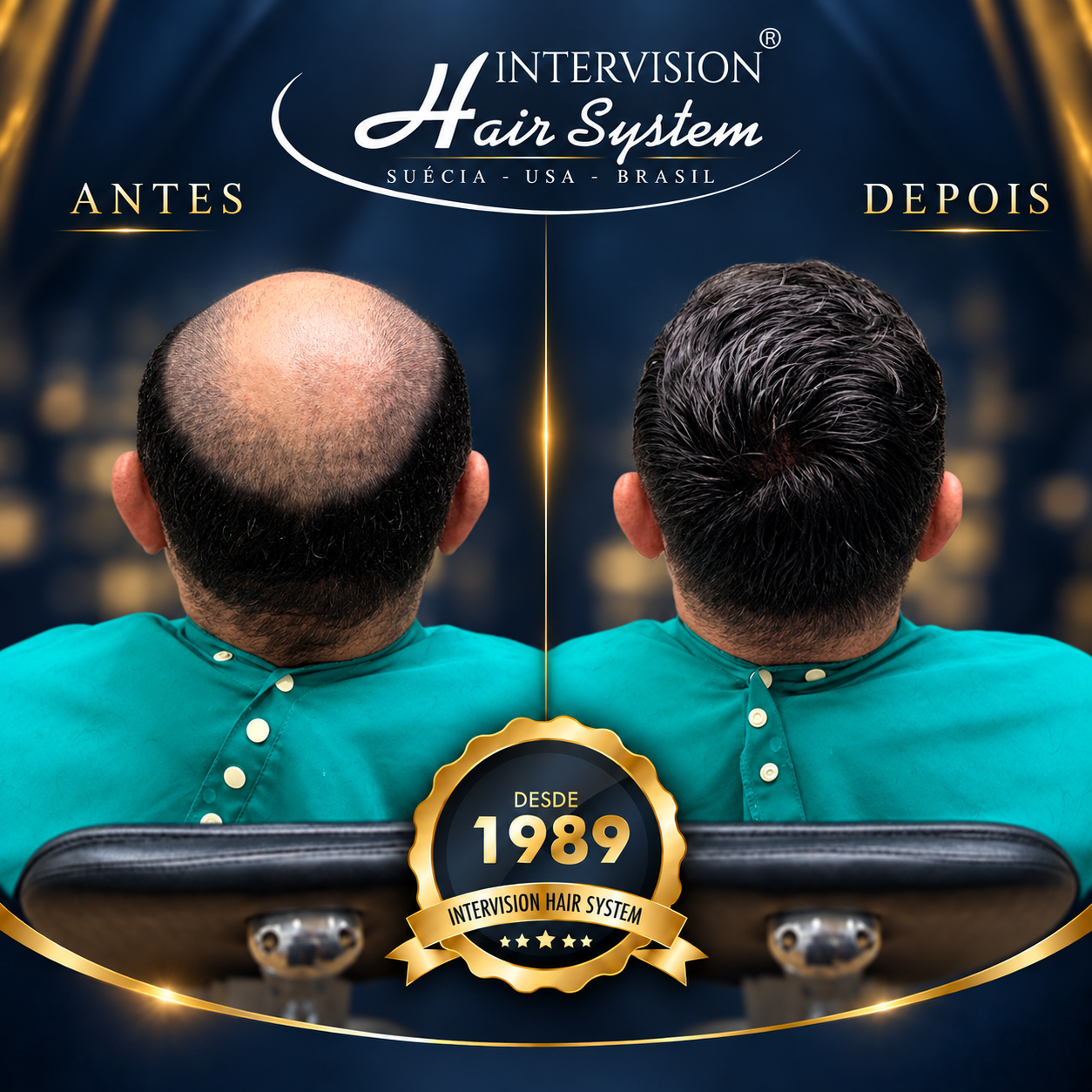 Antes e depois de prótese capilar - resultado real Intervision Hair System em Brasília 09