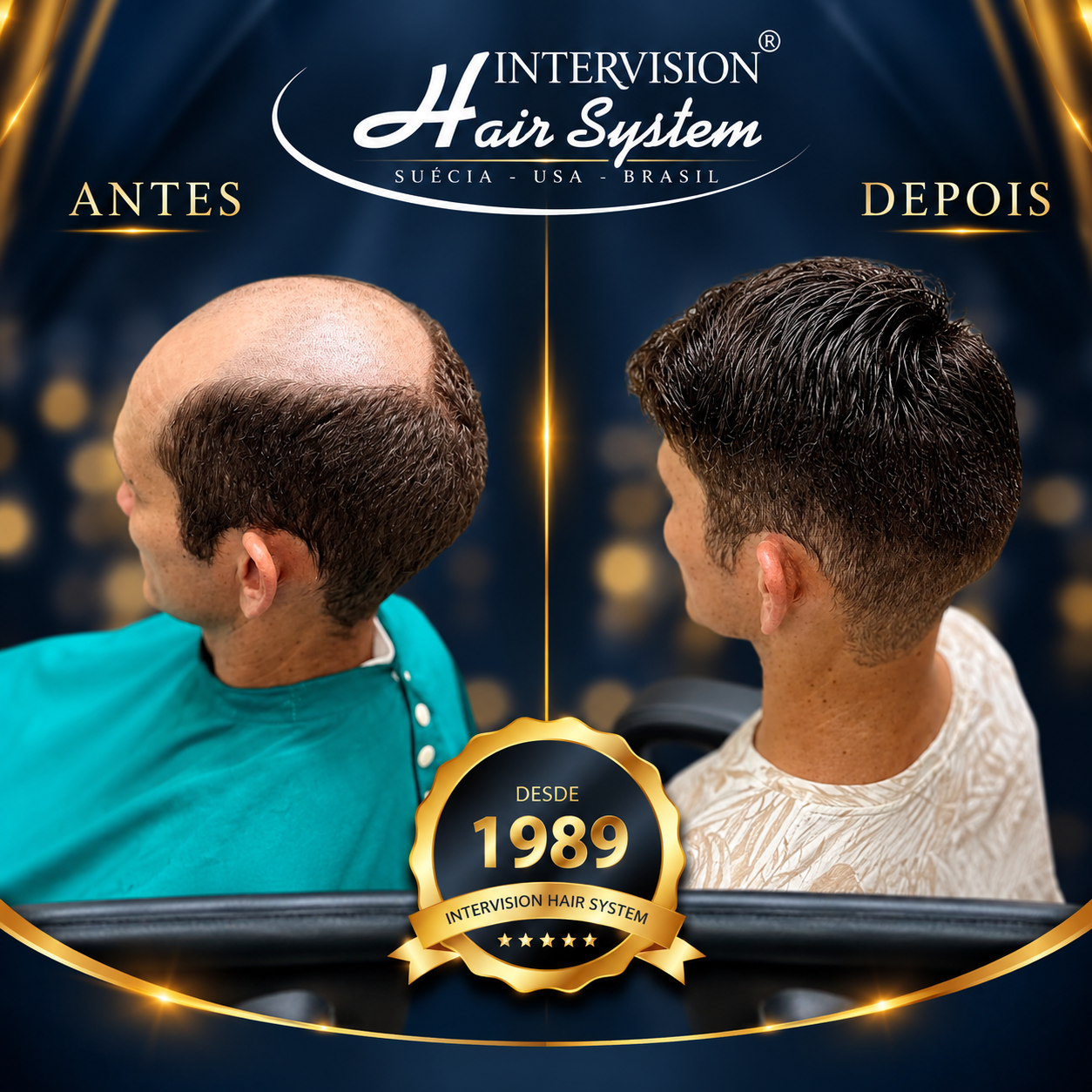 Antes e depois de prótese capilar - resultado real Intervision Hair System em Brasília 10