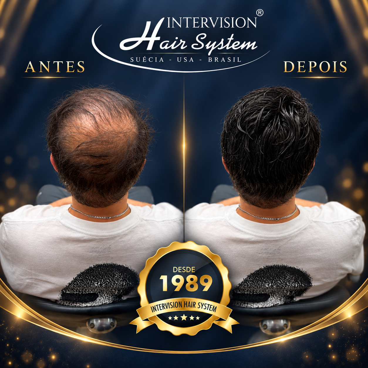 Antes e depois de prótese capilar - resultado real Intervision Hair System em Brasília 12