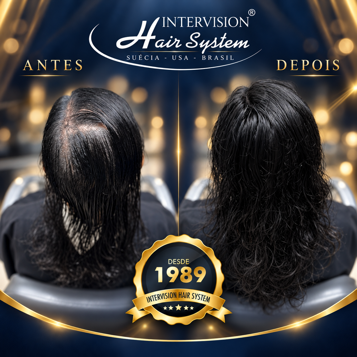 Antes e depois de prótese capilar - resultado real Intervision Hair System em Brasília 13