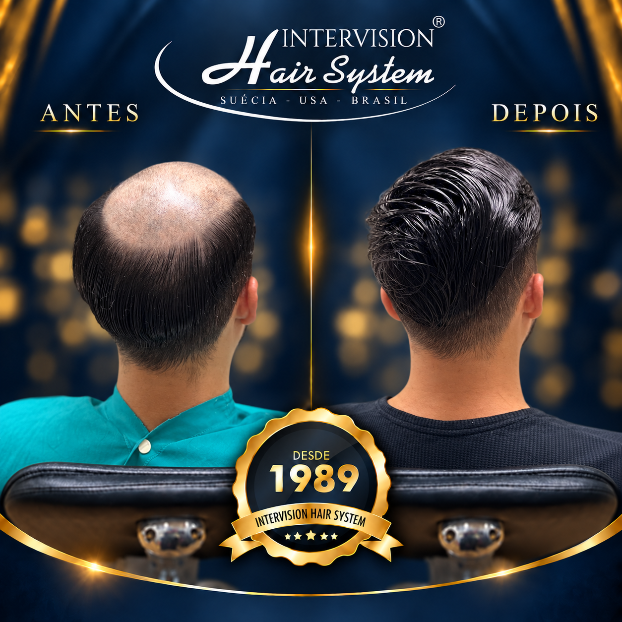 Antes e depois de prótese capilar - resultado real Intervision Hair System em Brasília 14