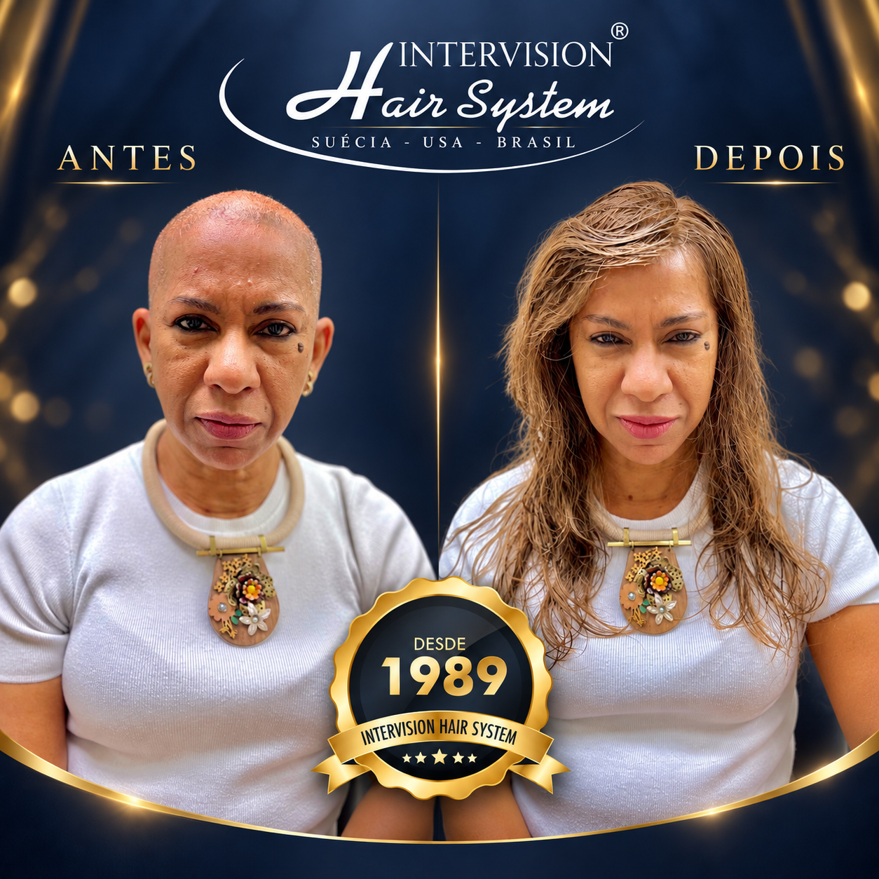 Antes e depois de prótese capilar - resultado real Intervision Hair System em Brasília 15