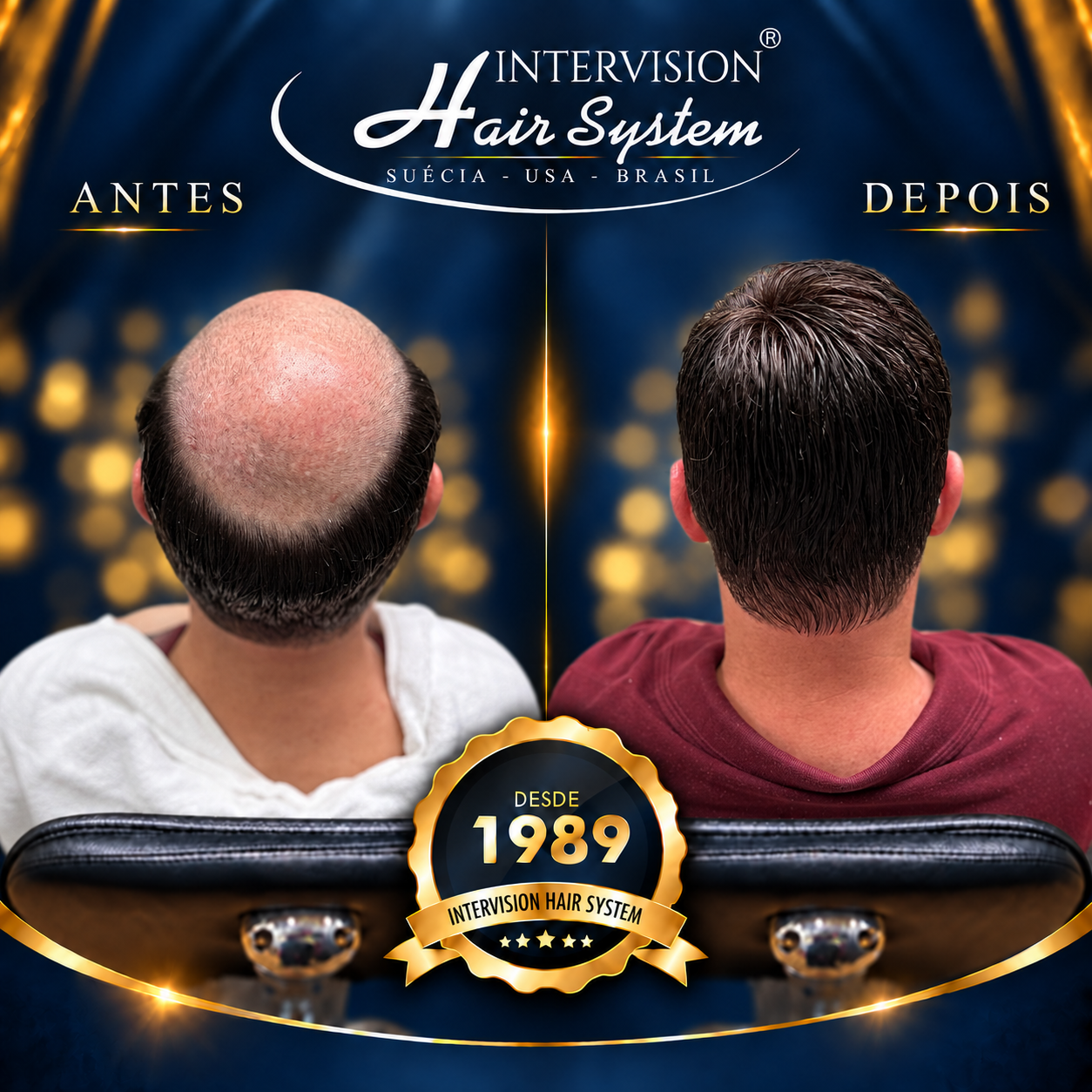 Antes e depois de prótese capilar - resultado real Intervision Hair System em Brasília 17