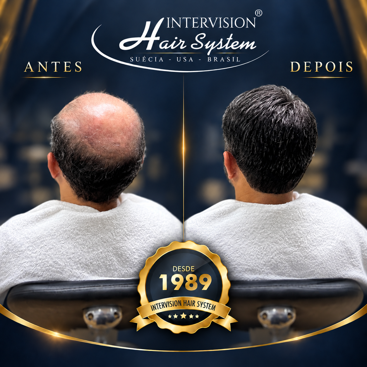 Antes e depois de prótese capilar - resultado real Intervision Hair System em Brasília 18