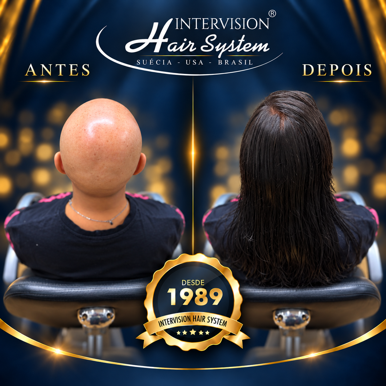 Antes e depois de prótese capilar - resultado real Intervision Hair System em Brasília 19