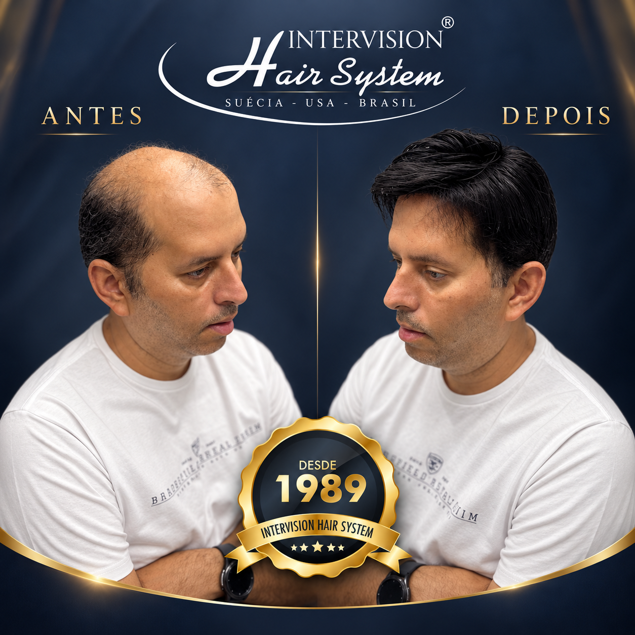 Antes e depois de prótese capilar - resultado real Intervision Hair System em Brasília 20
